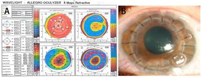 Case report: A case of acute postoperative endophthalmitis following penetrating keratoplasty due to carbapenem-resistant Klebsiella Pneumoniae and literature review